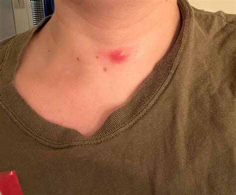 Exploring The Fascinating And Often Viral World Records For The Biggest Pimple Ever Documented By Medical Experts 3
