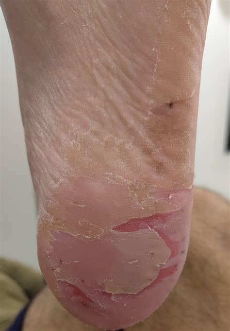 1197 best r/peeling images on Pholder | Peeling between my thumb and