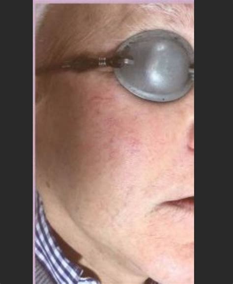 broken capillaries treatment melbourne victorian laser skin clinic