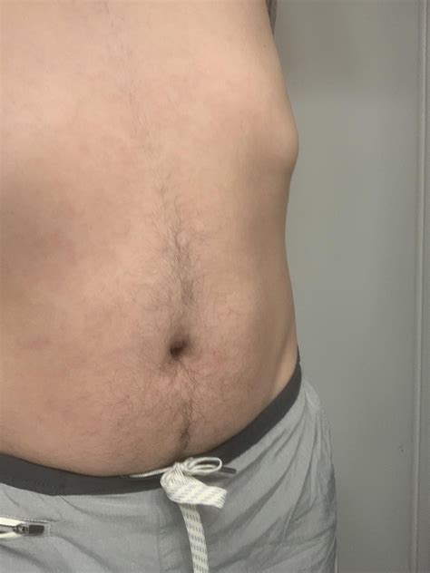 First time rash. Please see comment inside for more details : r/Dermatology