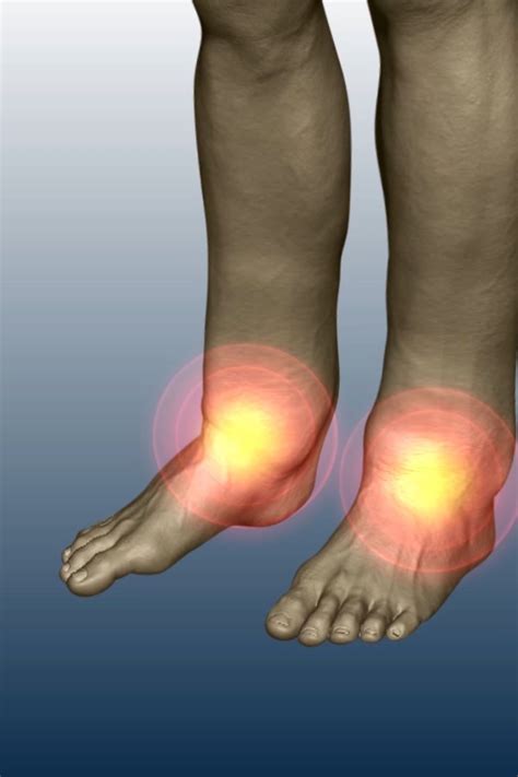 Peroneal tendonitis – Artofit