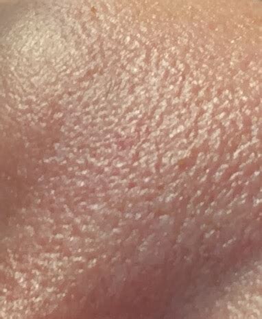 orange peel skin disaster  pictures page  general acne