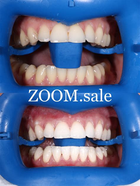 Отбеливание зубов Zoom 4 в Москве за 14500р. - отзывы, цена, акции и скидки