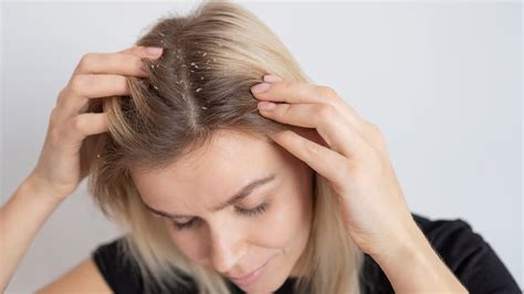 redness  scalp expert lists signs  scalp eczema   types