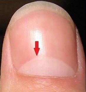 fingernails    health