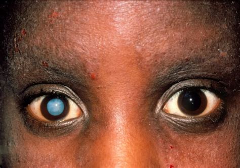 Cataract - Eye Disorders - MSD Manual Professional Edition