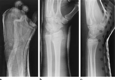 Casts and splint. (a) Radiograph shows a plaster of paris cast that ...