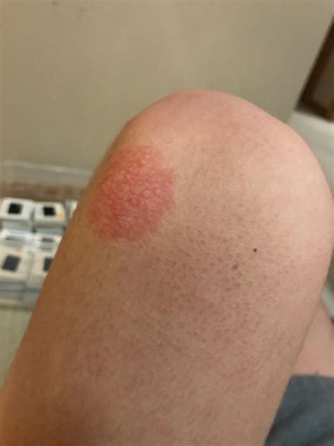 Red mark appeared on my knee a few weeks ago. Don’t know what it is and