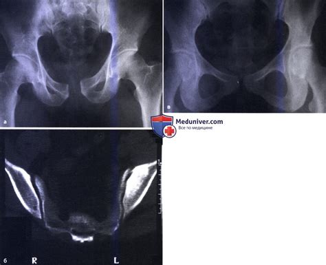 Агенезия крестца, агенезия симфиза, симфизеолиз: атлас фотографий