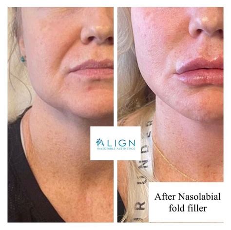nasolabial fold filler nasolabial fold filler nasolabial folds lips