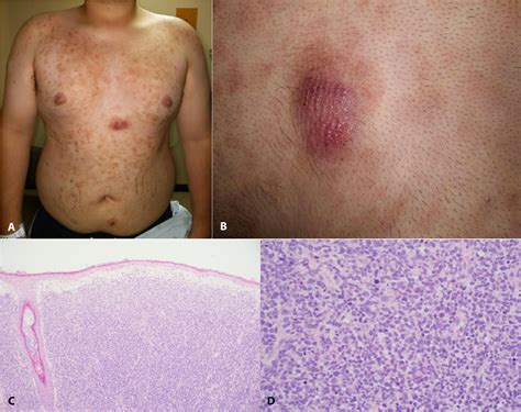 figure   blastic plasmacytoid dendritic cell neoplasm   young