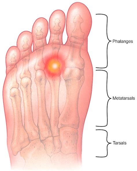 Foot Exercises To Relieve Metatarsalgia at Richard Schrader blog