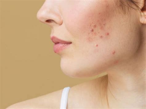 The Causes And Best Treatment Of Hormonal Acne | Taiz Mind