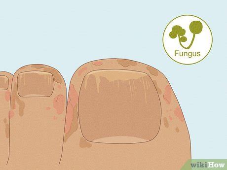 how to fix split toenail