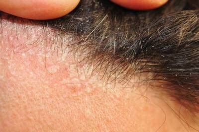 O Que É Seborreia No Cabelo - Seborreia no couro cabeludo: saiba causas, sintomas e tratamentos
