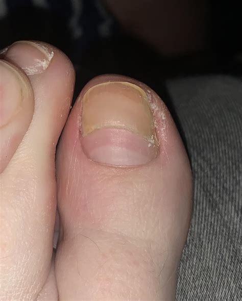 toenail grew  extra thick   pregnancy  abruptly