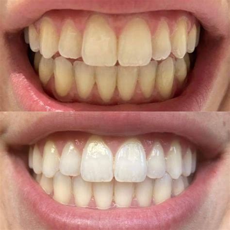 gem natural whitening  ml gem au artofit