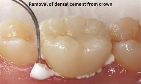 how to remove dental cement from crown at home