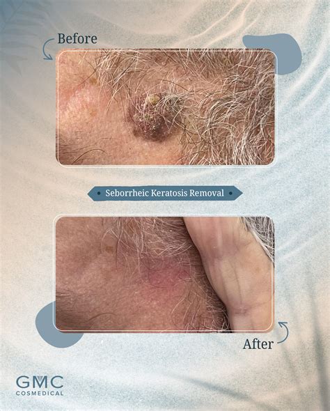 GMC - Shown here are before and after photos of a Seborrheic Keratosis
