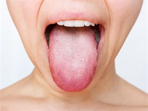 What Causes White Patches On Your Tongue - Infoupdate.org