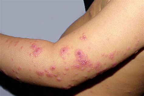 eczema herpeticum pictures stages  treatment