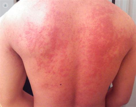What Is Histamine Intolerance? - Thingsisawtoday