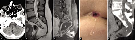 Pilonidal Cyst Mri
