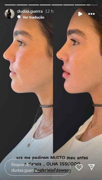 Duda Guerra Antes E Depois - Namorada de Benício Huck faz harmonização facial e mostra antes e ...
