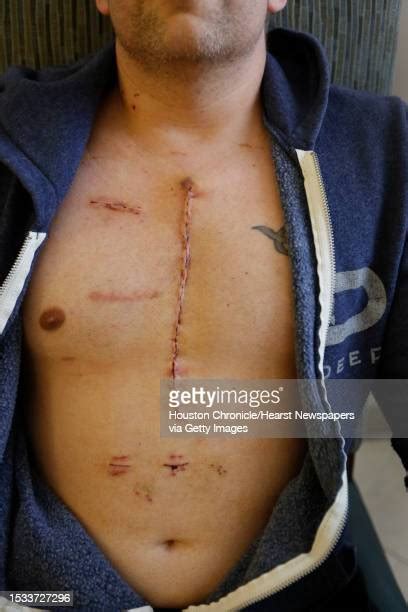 26 Open Heart Surgery Scar Stock Photos, High-Res Pictures, and Images ...