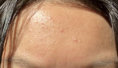 [Routine Help] Small Bumps on Forehead : r/SkincareAddiction