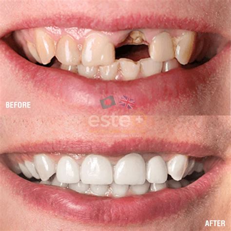 root canal este medical bangladesh  uks leading skin body