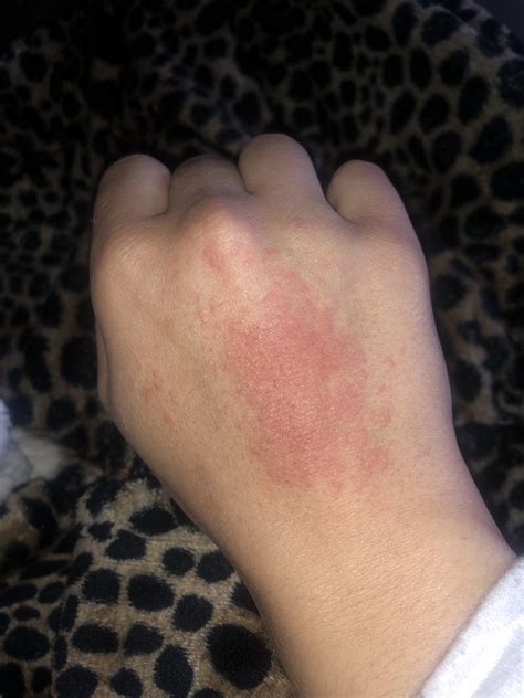 Rash on hand, Itches slightly, somewhat dry. : r/medical_advice