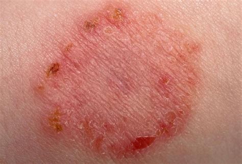 O Que É Erupção Na Pele - Erupção Cutânea Vermelha E Pruriginosa - RETOEDU