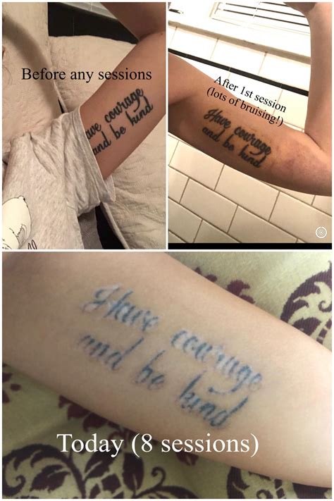 reddit tattoo removal 8