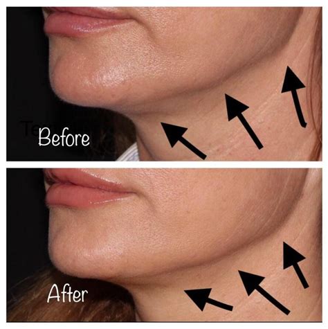 jowl before and after - Newport Beach Dermatology & Plastic Surgery