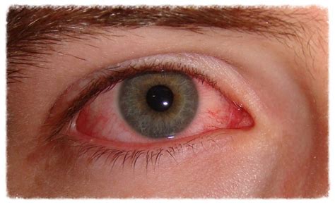 AZ Red Eye Experts - Advanced Treatment for Chronically Red Eyes ...