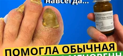 Методы лечения грибка ногтей: эффективные способы избавления от ...