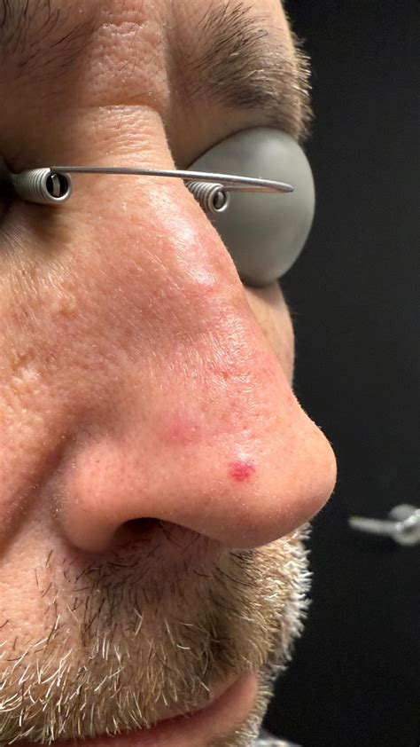 Actinic Keratosis Nose