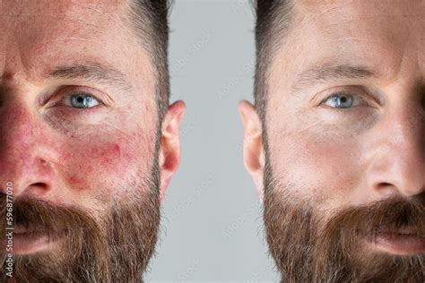 Before and after a rosacea laser treatment Stock Photo | Adobe Stock