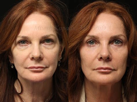 Before and 6 months after upper and lower blepharoplasty surgery with