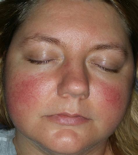 hive on face