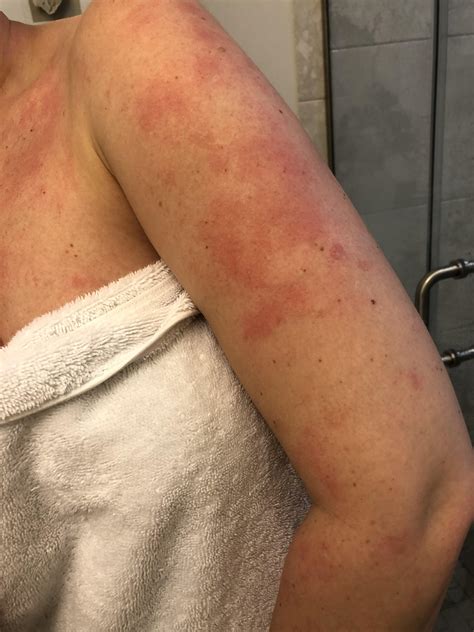 Sandpaper Rash On Upper Arms at Nilsa Sutton blog