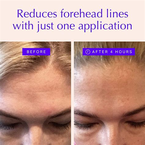 Forehead & Eye Wrinkle Patches - Overnight Anti-Wrinkle Treatment