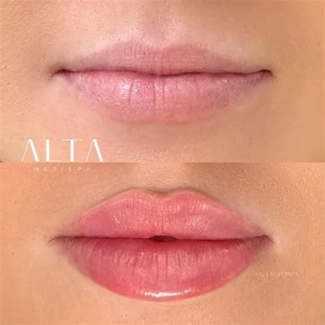 Natural Lip Filler Before & After | Stunning Results ALTA