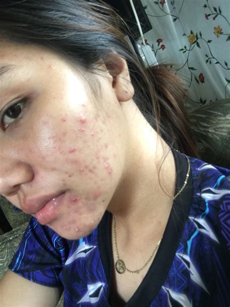 Can’t figure out if this is an allergic reaction or breakout