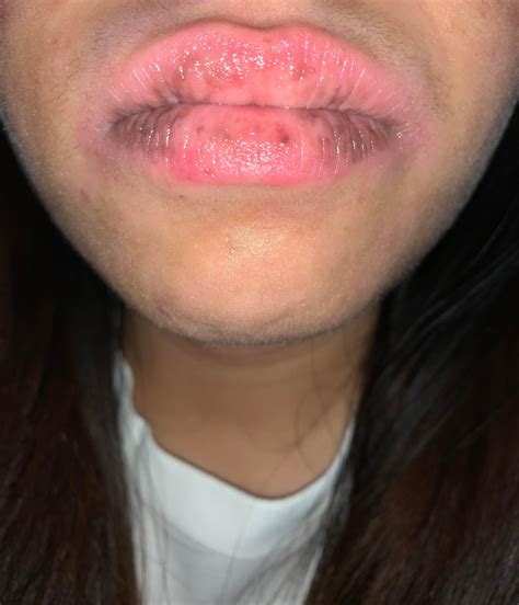 Why is there black patches and spot on my lips and how do I get rid of