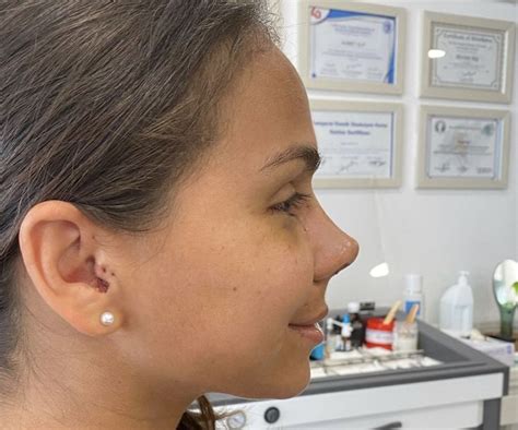 Upturned nose | Nose job, Rhinoplasty nose jobs, Pretty nose 