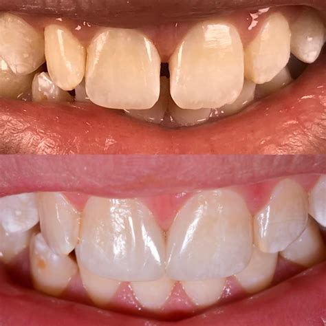 Diastema closure with Direct Composite - MyZerodonto