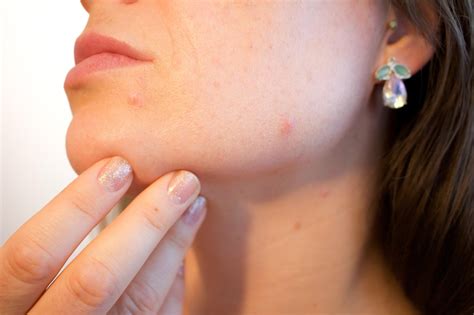 pimple acne images pixabay
