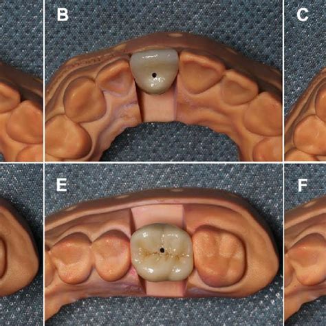 The lingual and occlusal views of crowns on casts with different access ...